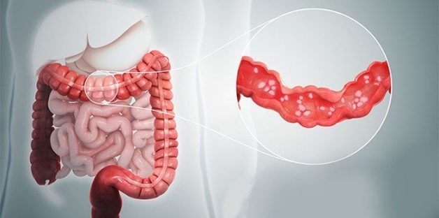 Đoạn đại tràng bị viêm cấp tính