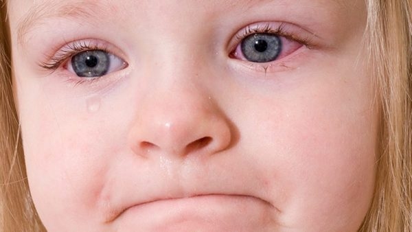 Viêm kết mạc sơ sinh