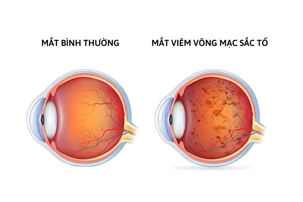Các tế bào trong võng mạc dần thoái triển khiến tầm nhìn mắt bị thu hẹp và giảm sút thị lực.