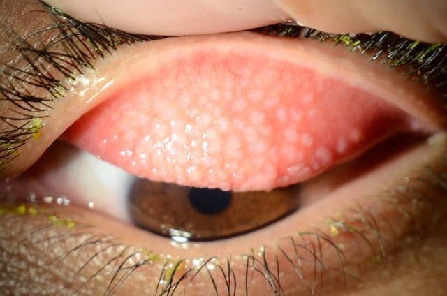 Chuyên gia giải đáp: Bị mắt hột phải làm sao?
