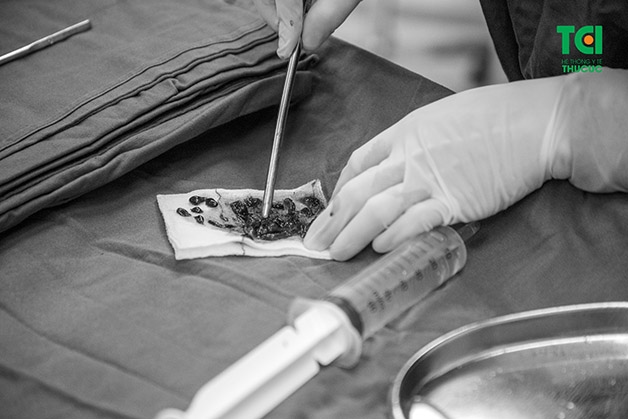 U xơ tử cung có thể là tiền đề cho việc hình thành polyp tử cung