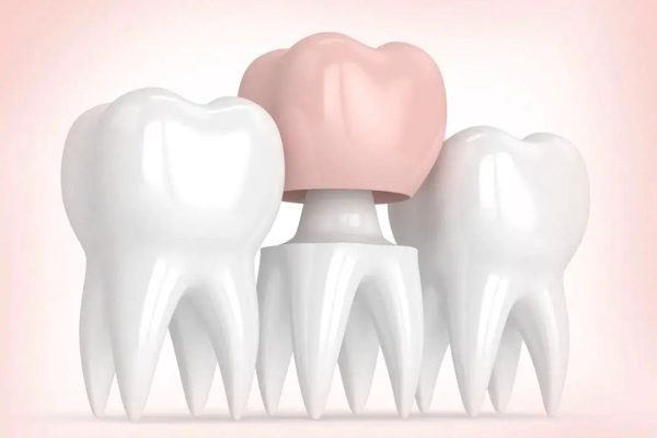 Bọc sứ là kỹ thuật phục hình răng thông qua việc gắn mão sứ lên trên bề mặt răng thật