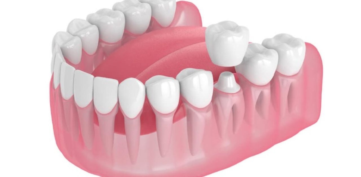 Giải đáp: Vì sao bọc răng sứ xong bị lung lay?
