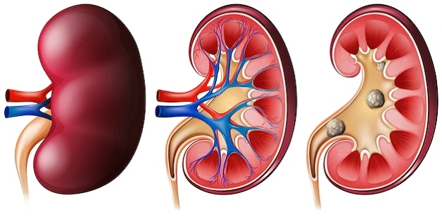 Điều trị sỏi kẹt niệu đạo như thế nào để đạt hiệu quả sạch sỏi triệt để
