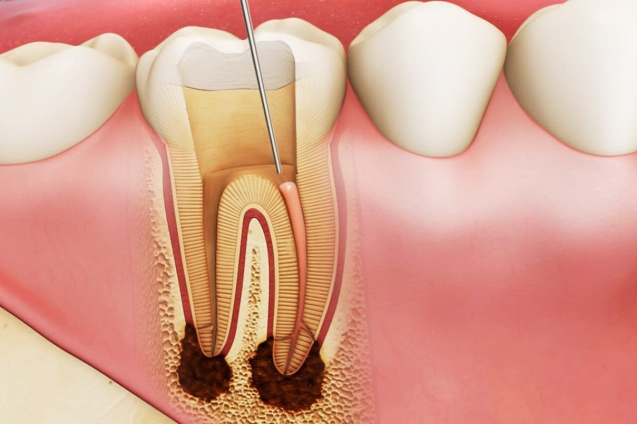 Điều trị tủy răng sâu có cần thiết?