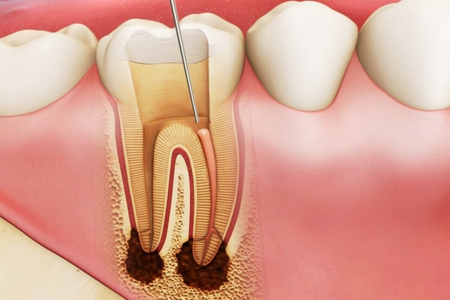 Điều trị tủy răng sâu có cần thiết?