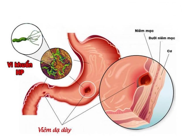 Tổn thương do viêm loét gây ra các cơn đau dạ dày