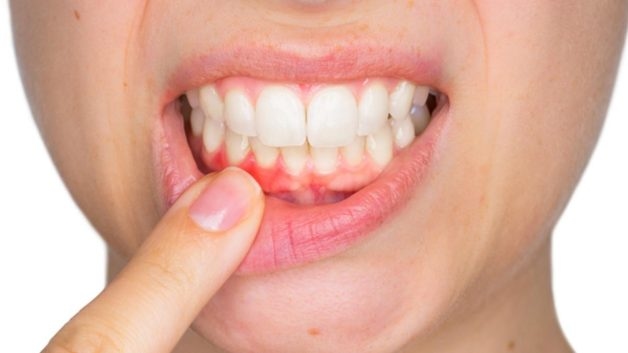 Sưng lợi có thể là biểu hiện của bệnh lý viêm lợi hay viêm nướu