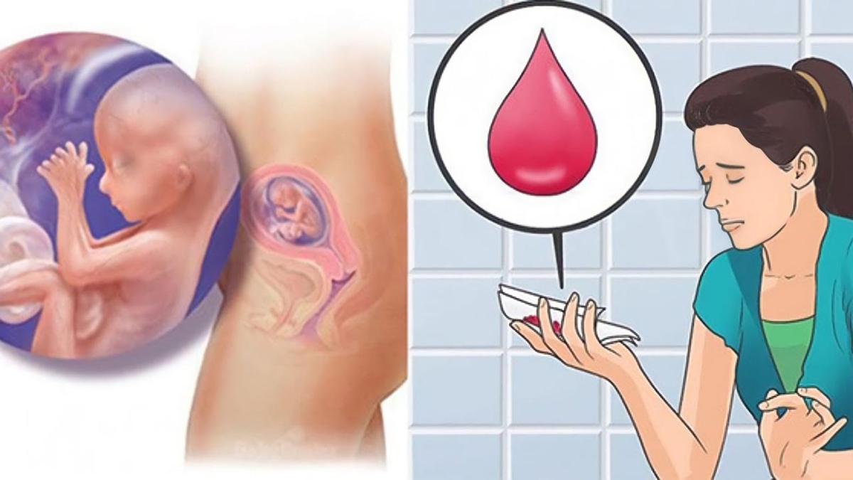 Hiện tượng rong kinh sau sảy thai và những điều cần lưu ý