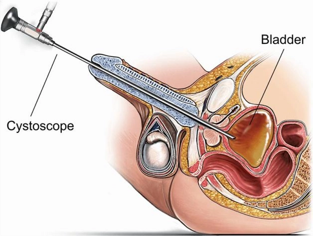 Những lưu ý trước và sau tán sỏi nội soi ngược dòng bằng laser