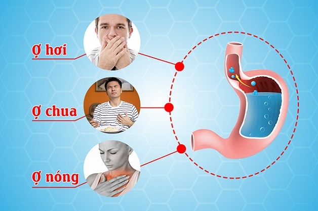 dấu hiệu dạ dày trào ngược là ợ hơi, ợ chua, ợ nóng