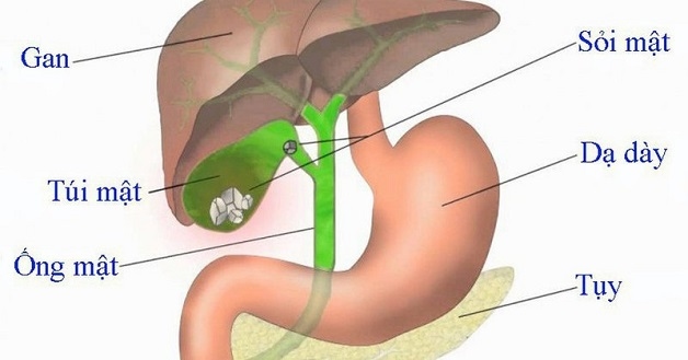 Mổ mở cắt túi mật chỉ định khi nào