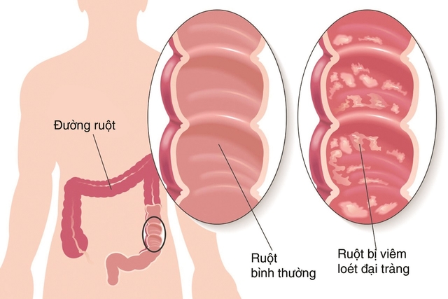 Nguyên nhân, triệu chứng và cách chữa bệnh viêm đường ruột