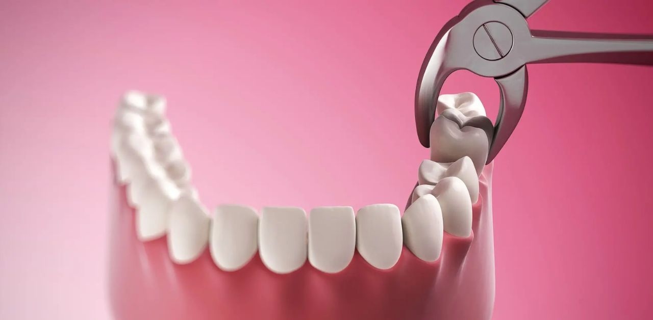 Xử lý răng khôn mọc ngang đúng cách