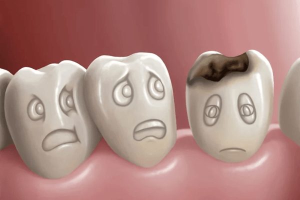 Sâu răng là tình trạng tổ chức răng bị tổn thương do quá trình hủy khoáng vi khuẩn gây ra