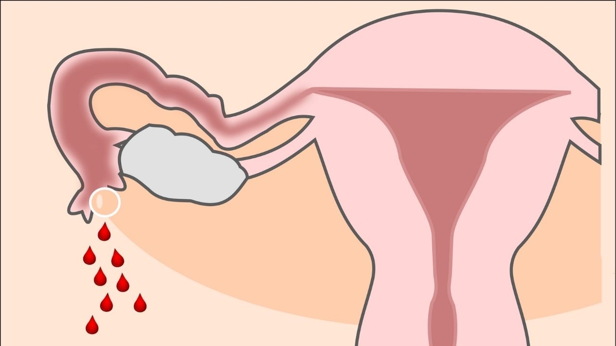 Mấy tuần có thể phát hiện chửa ngoài tử cung?