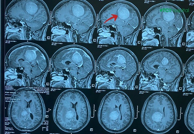 Đau đầu trong u não như có vật gì đó đè nặng