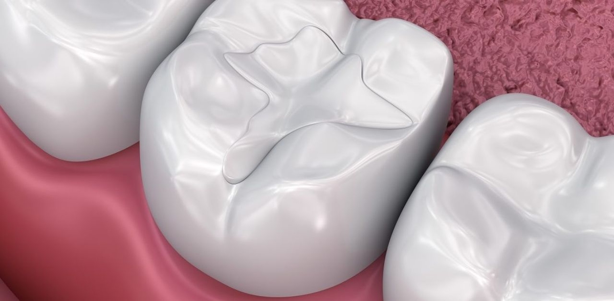 Hàn răng xong bị đau do đâu, khắc phục như thế nào?