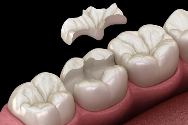 Miếng trám không khớp tạo ra khe rỗng, tăng áp suất tới cầu trúc răng và tác động tới ống ngà