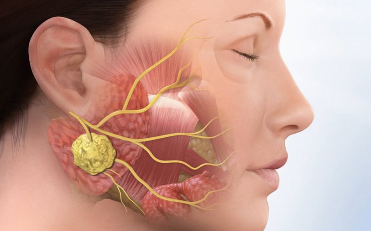 Thông tin cơ bản về khối u xương hàm lành tính và ác tính