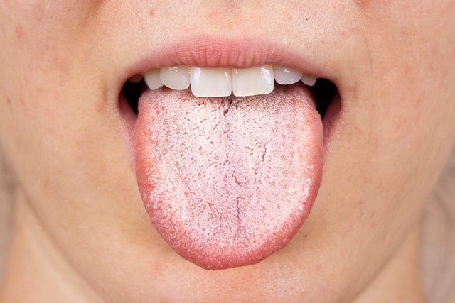 Nấm miệng: Nhận biết, điều trị và phòng ngừa tái phát