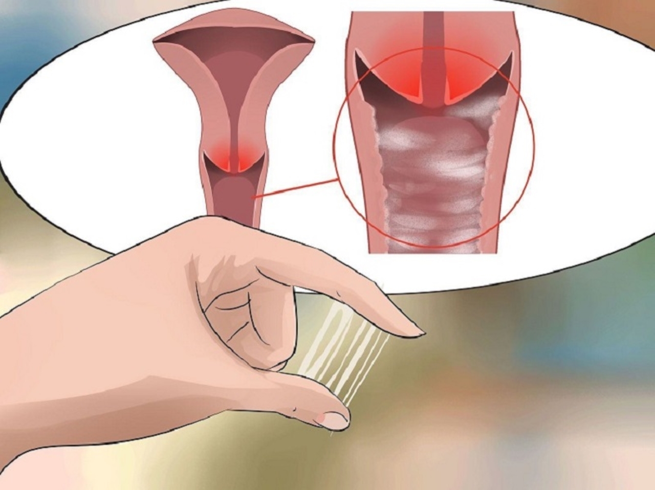Cách để trị tận gốc và ngừa tái phát bệnh nấm ở vùng kín?