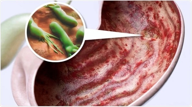 Nguyên nhân gây loét dạ dày tá tràng