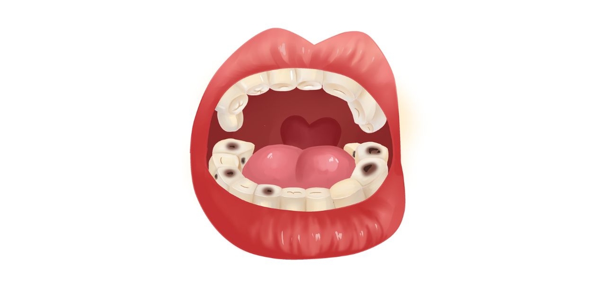 Răng số 6 bị sâu: Nguyên nhân, dấu hiệu, cách khắc phục