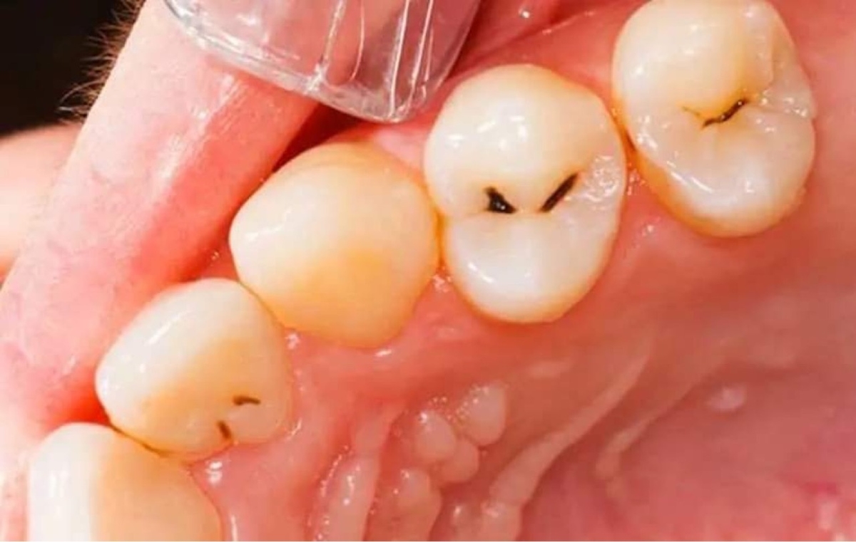 Sâu men răng và cách điều trị tối ưu