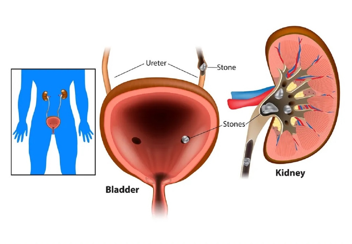 Siêu âm sỏi bàng quang &#8211; Cách sử dụng để chẩn đoán sỏi