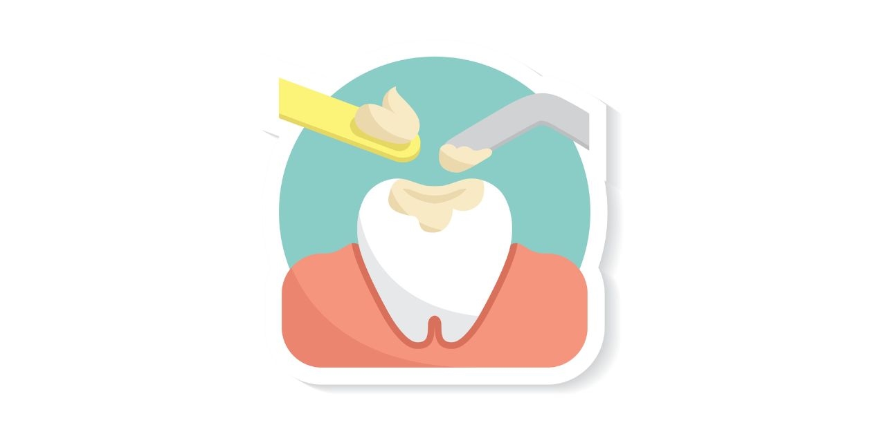 Trám răng bằng composite là gì, có bền không?