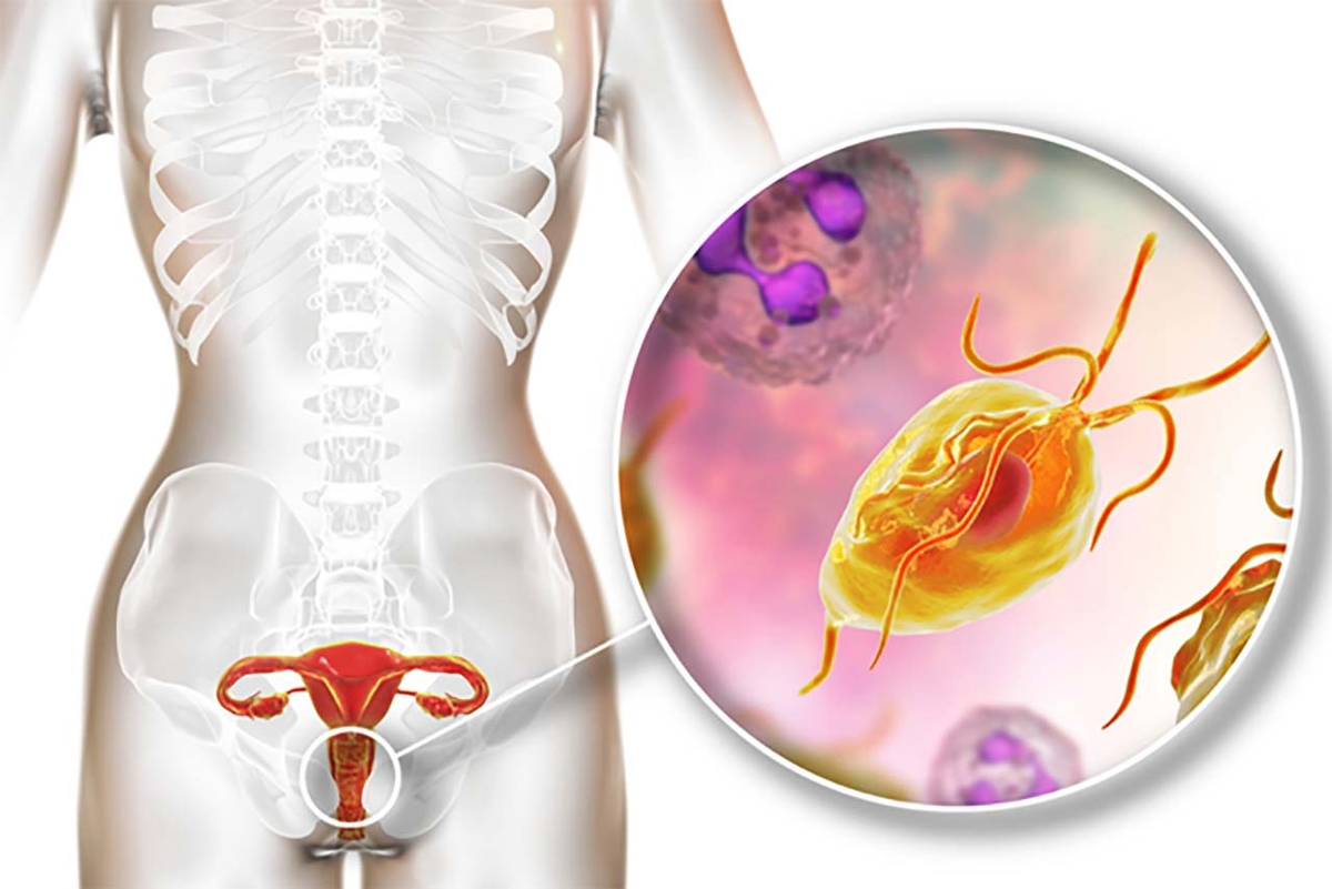 Trùng roi âm đạo, nguyên nhân gây viêm âm đạo chị em nên cảnh giác