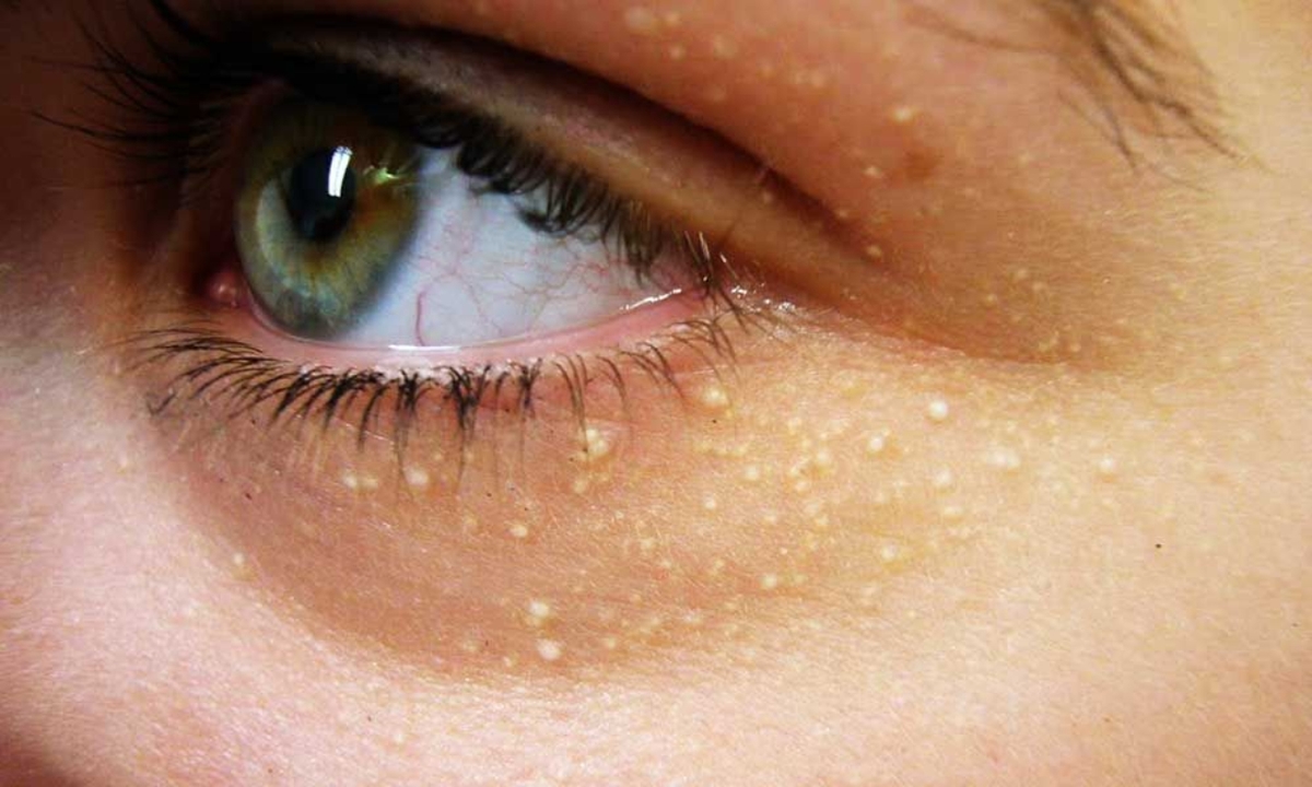 U mỡ vàng mi mắt: Mọi điều bạn cần biết