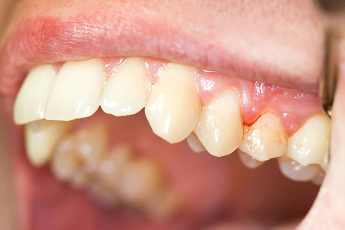 Chuyên gia giải đáp: Viêm lợi có phải nhổ răng không?
