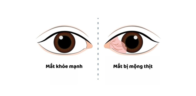 Bệnh mộng thịt ở mắt: Nguyên nhân, dấu hiệu, cách điều trị