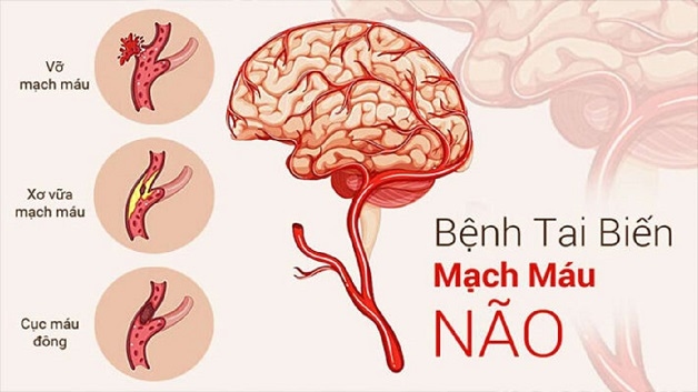 Nguyên nhân chính gây tai biến mạch máu não hay còn gọi đột quỵ não