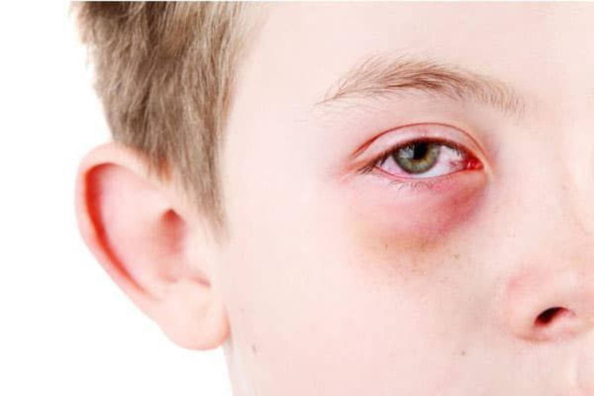 Chuyên gia giải đáp: Đau mắt đỏ bao lâu khỏi?