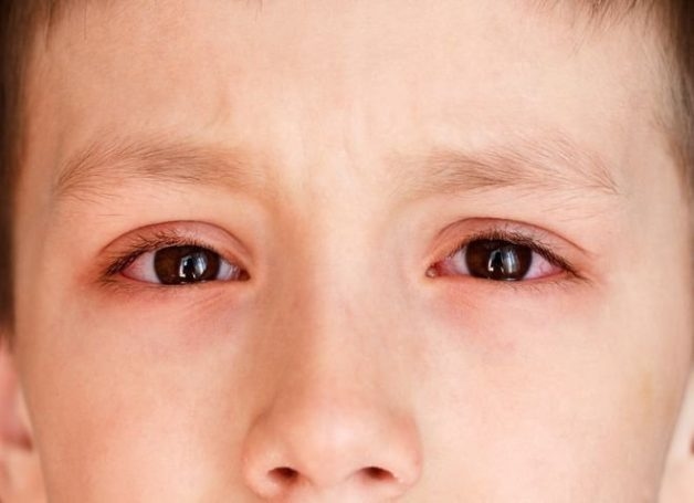 dấu hiệu đau mắt đỏ ở trẻ em