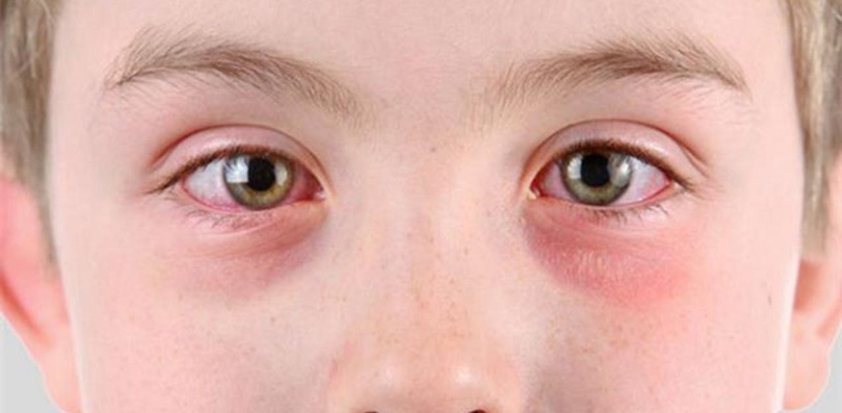 Đau mắt đỏ ở trẻ sơ sinh &#8211; Nguyên nhân do đâu?