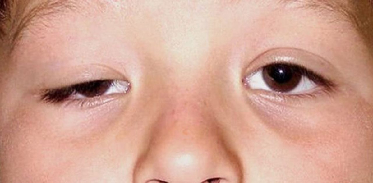 Mắt bị sụp mí 1 bên có nguy hiểm không? Làm gì để cải thiện?
