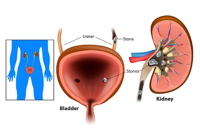 Điều trị ngoại khoa &#8211; mổ sỏi bàng quang