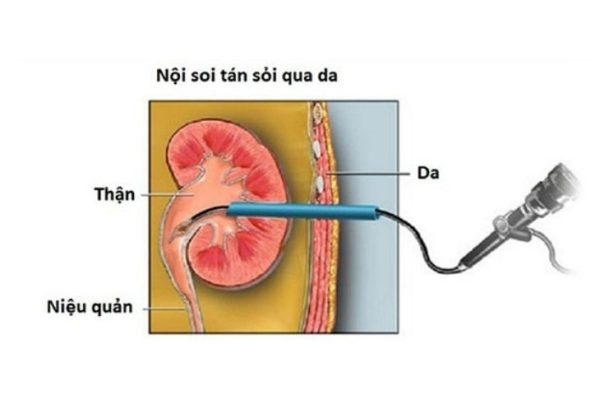 phương pháp tán sỏi thận qua da