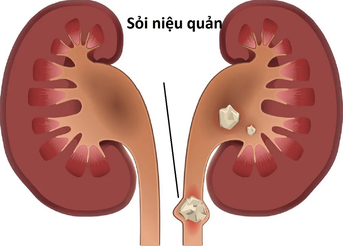 Giải đáp: Sỏi niệu quản có tán được không?