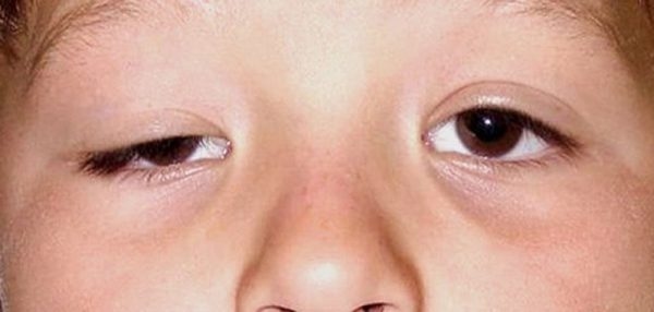 sụp mí mắt