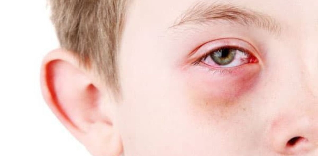Trẻ mắc viêm kết mạc bao lâu thì khỏi?