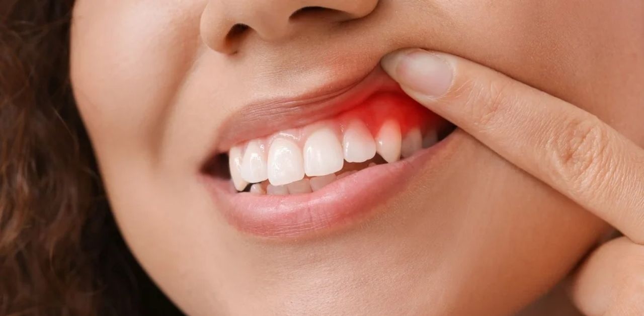 Nhận biết các triệu chứng viêm chân răng