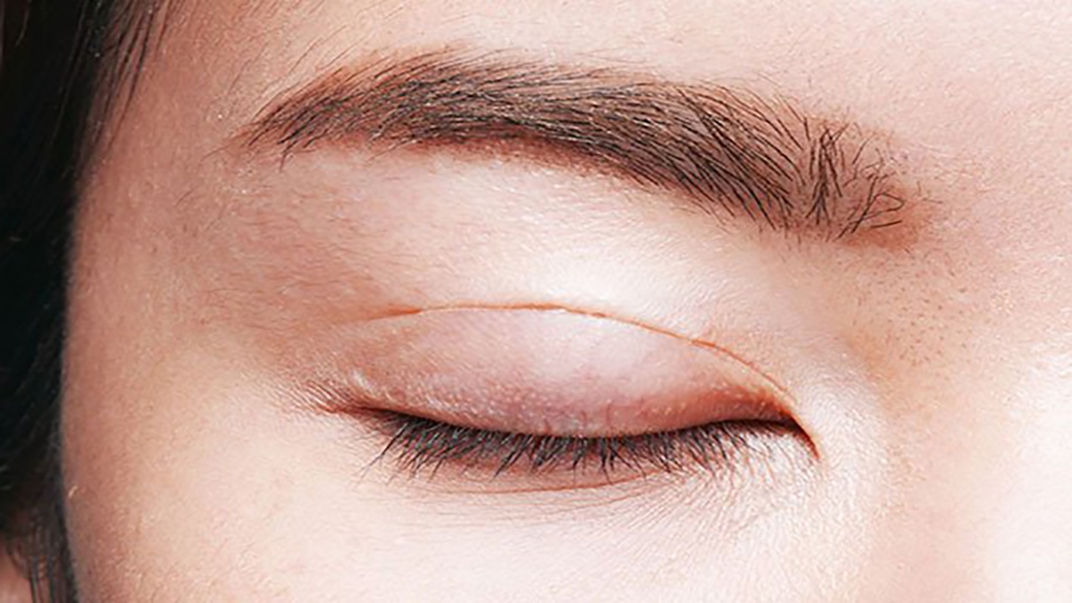 Làm gì khi bị u bã đậu ở mí mắt?