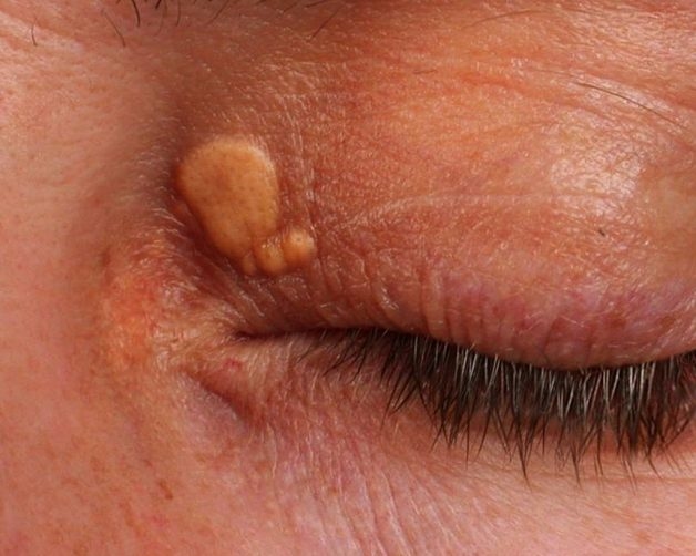 U mỡ vàng là những u nhỏ hoặc những mảng thâm nhiễm màu vàng