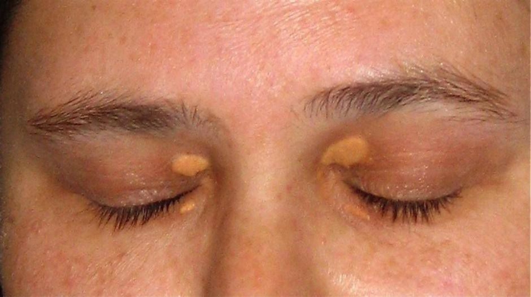 U mỡ vàng ở mắt: Nhận biết và điều trị