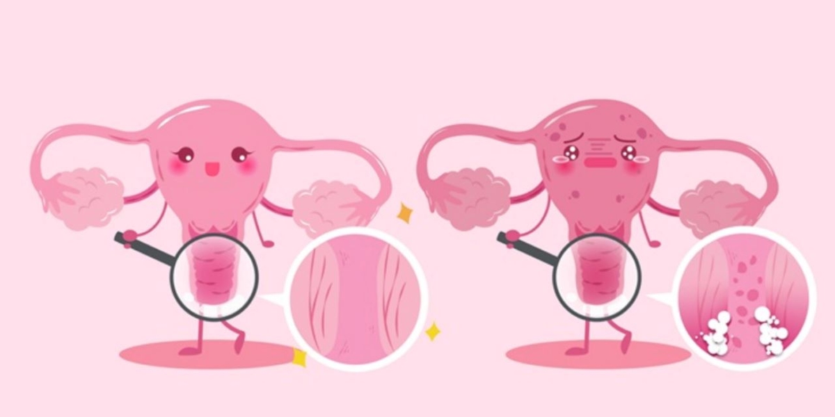 Viêm âm đạo do tạp khuẩn ở nữ giới và cách điều trị